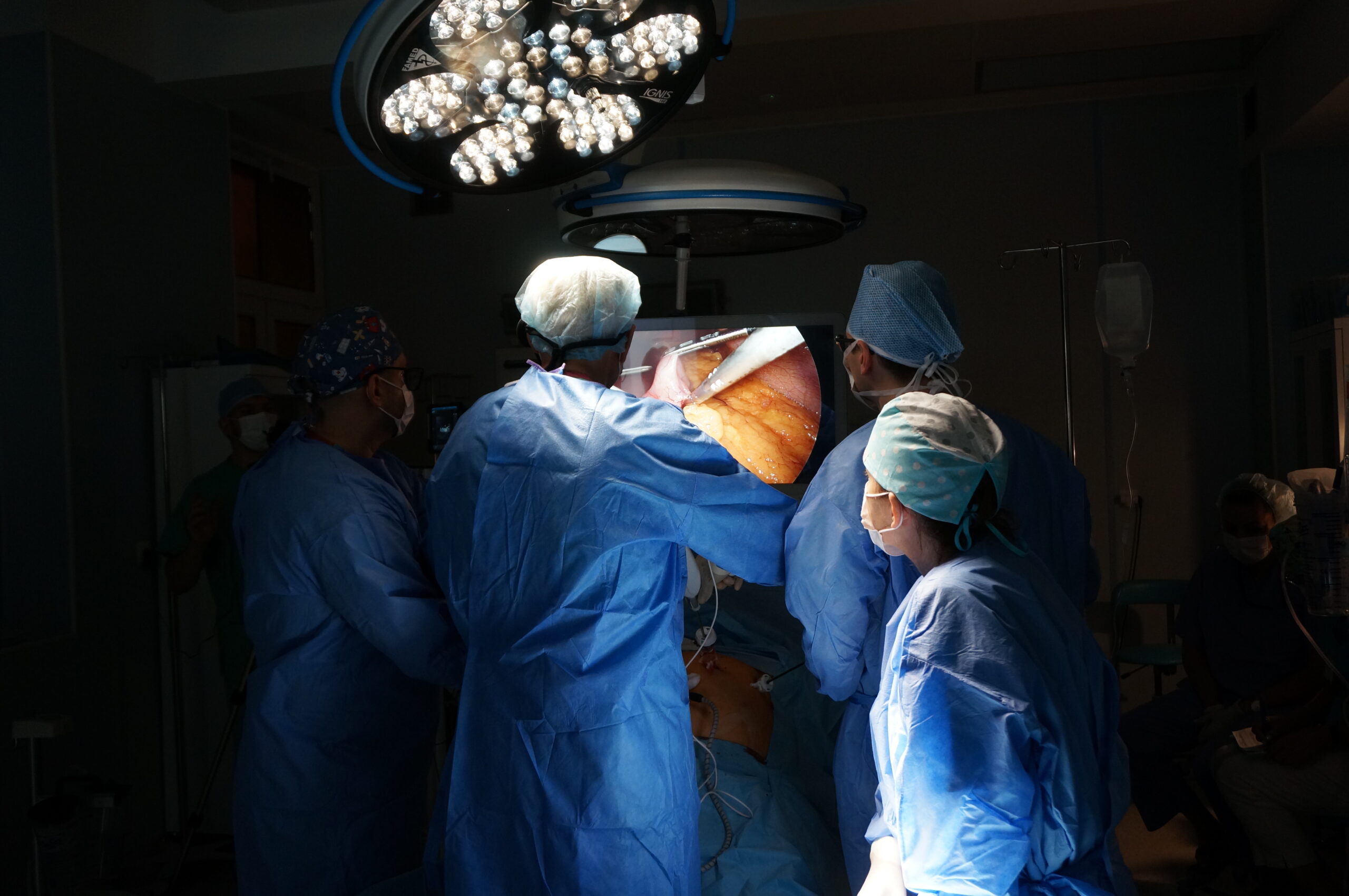 Operacja laparoskopowa resekcji żołądka